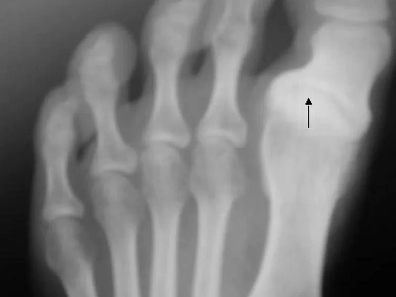 Information about Hallux varus and how to correct it